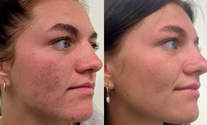 acne scars improved with dermapen and exosomes at true medispa twickenham 