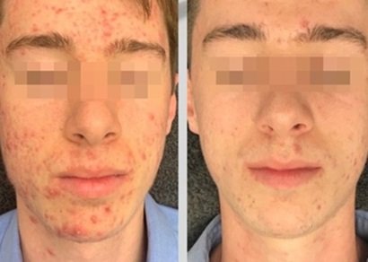 before after acne treatments